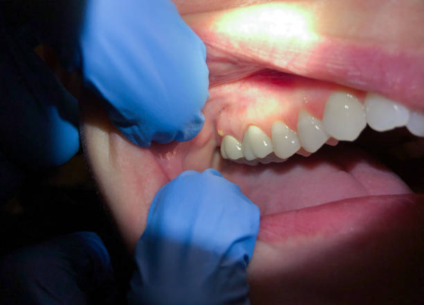 Best Emergency Broken Tooth Repair in Lake Magdalene, FL